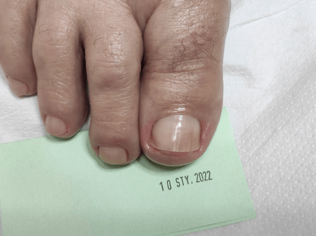 Paznokieć po terapii
