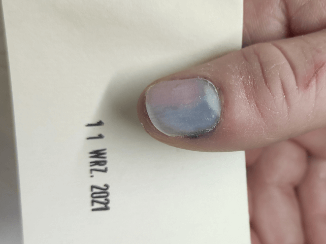 Przykład krwiaka podpaznkciowego - sytuacja przed