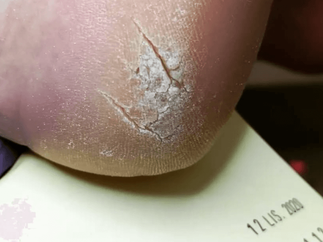 Zrogowacona pękająca skóra na pięcie