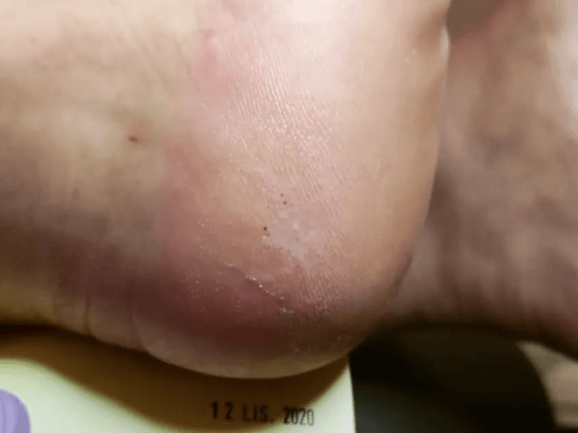 Pięta po zastosowanej terapii. Skóra nawilżona, bez zrogowaceń, gojąca się.