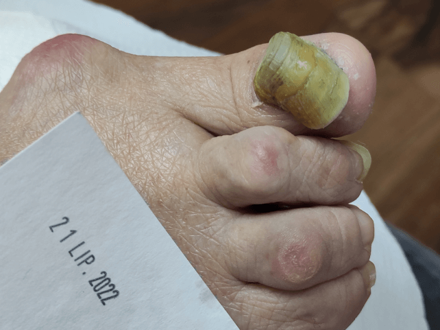 paznokieć szponowaty