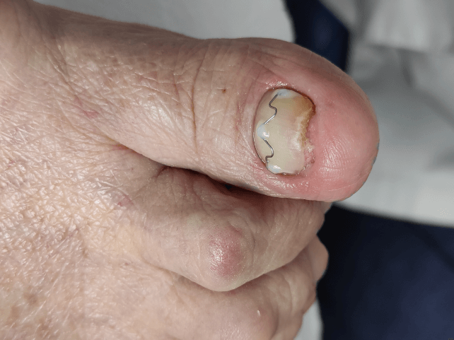 paznokieć z klamrą ortonyksyjną. Klamra ortonyksyjna